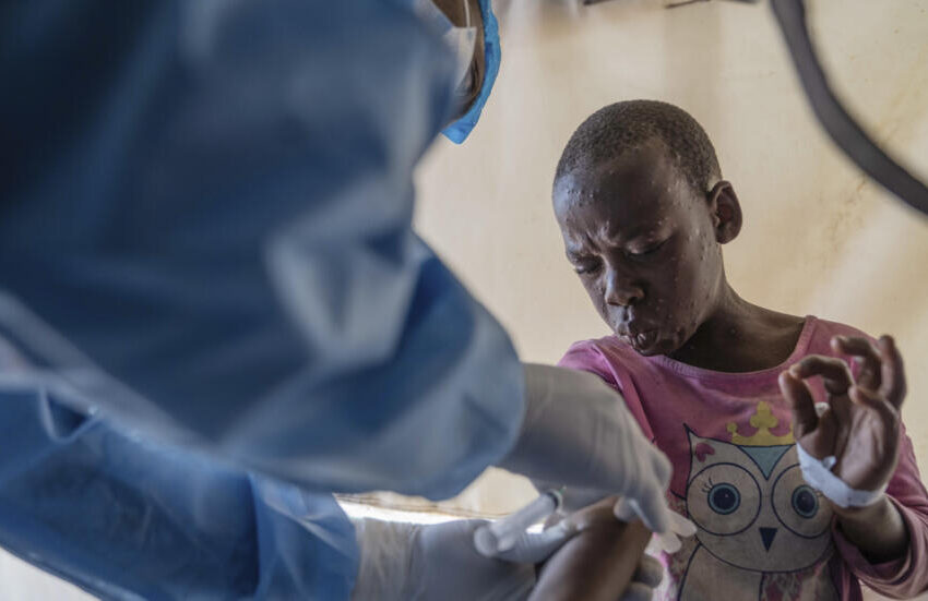  Direcção Nacional de Saúde fala em situação de “risco elevado” por força da progressão do vírus Mpox na RDC