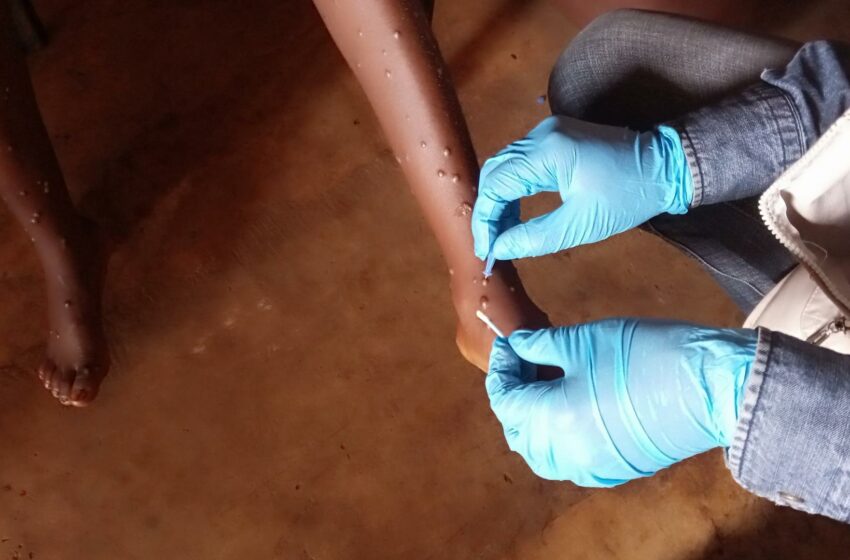  Resultado do caso suspeito de mpox na província de Cabinda deu negativo