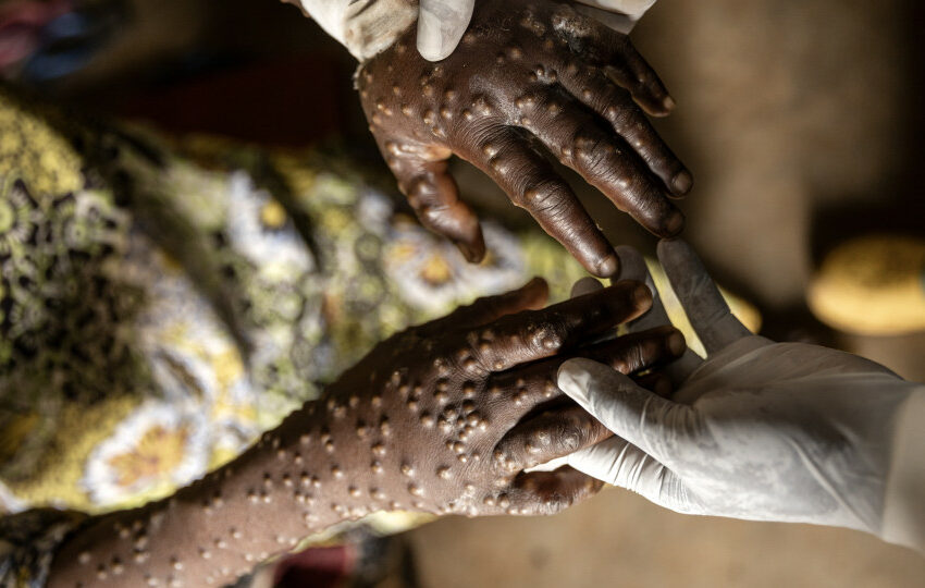  África com 26.550 casos e 724 mortes devido à Mpox desde o início do ano
