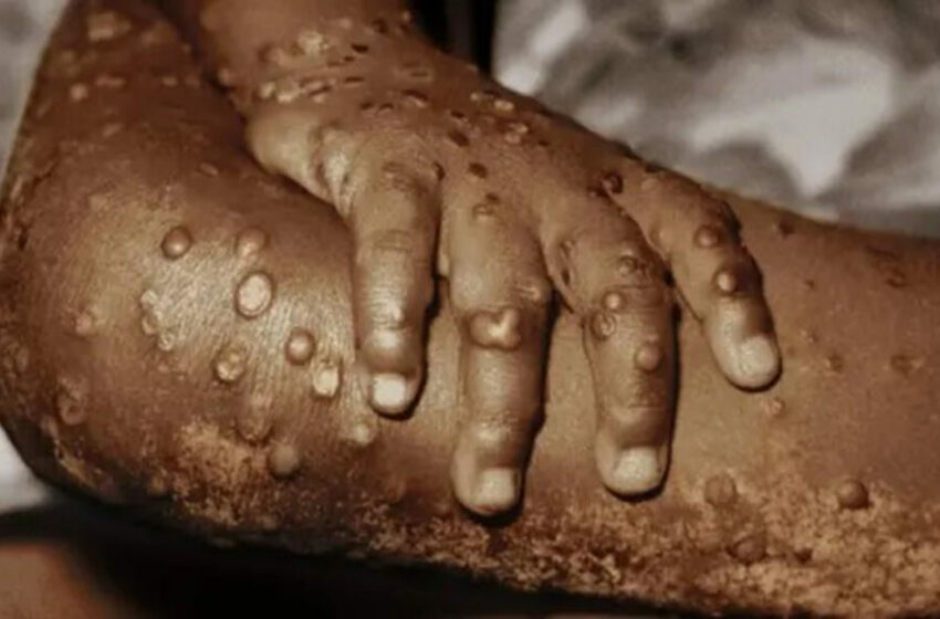  Terceiro caso de Mpox em Angola é confirmado no Uíge
